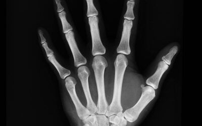 Does Arthritis Damage the Joints?